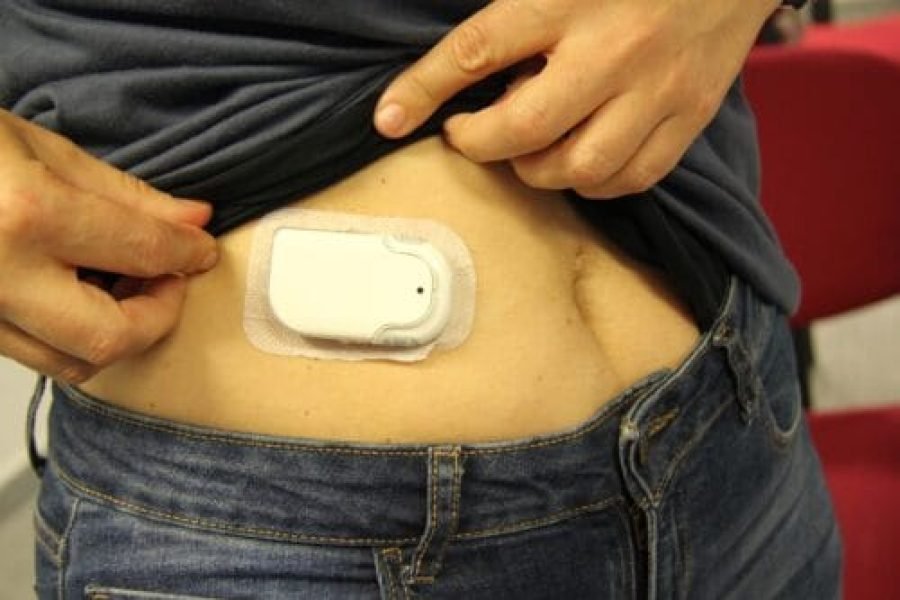 Bomba de insulina implantada